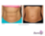 body thermage in markham tighting loosing stomach skin