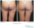 thermage-before-after1