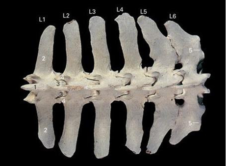 Case Study - Transitional Vertebrae