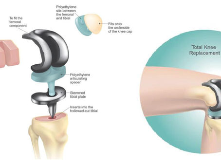 以模型的方式，預測在全膝關節置換術後脛骨植入物厚度的生物力學影響