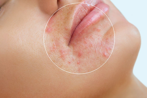 unreine Haut, Akne, Pickel, Tiefenreinigung, Pickel ausdrücken, Haut beruhigen, Gesichtsbehandlung, Kosmetikerin Volketswil, Irritationen der Haut, Maskentragen, Maskenpflicht, Corona