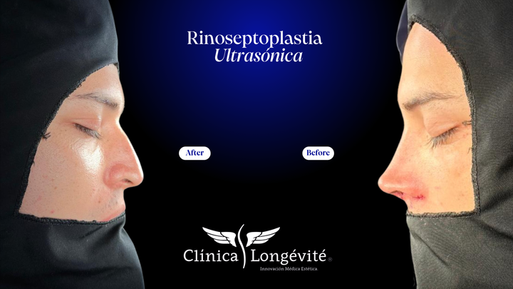 "Antes y después de un caso de éxito en la clínica Longevité, mostrando resultados de [nombre del procedimiento] y resaltando la evolución estética y armonía facial/corporal lograda."