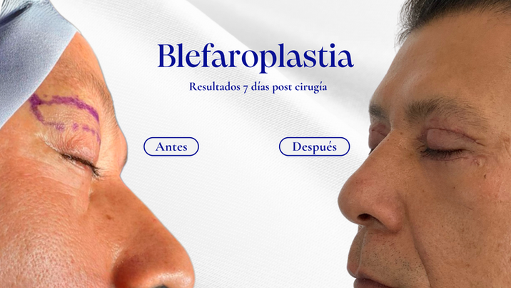 "Antes y después de un caso de éxito en la clínica Longevité, mostrando resultados de [nombre del procedimiento] y resaltando la evolución estética y armonía facial/corporal lograda."