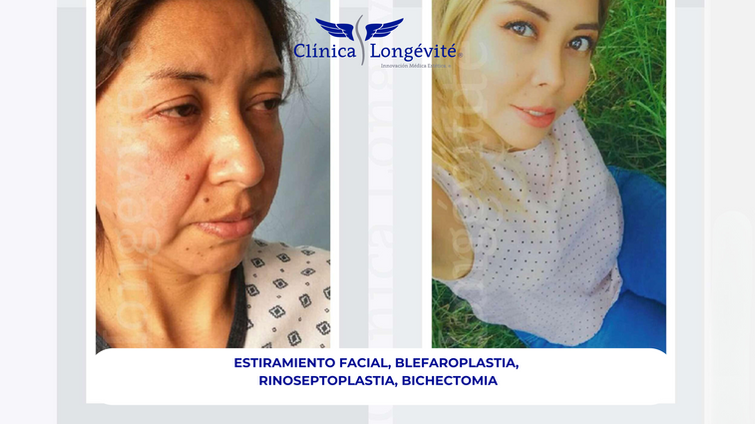 "Antes y después de un caso de éxito en la clínica Longevité, mostrando resultados de [nombre del procedimiento] y resaltando la evolución estética y armonía facial/corporal lograda."