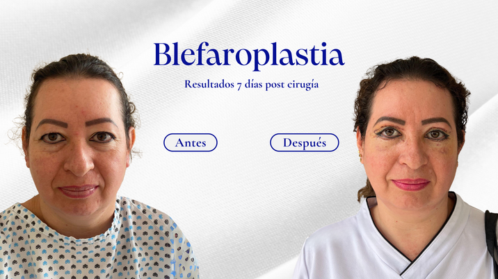 "Antes y después de un caso de éxito en la clínica Longevité, mostrando resultados de [nombre del procedimiento] y resaltando la evolución estética y armonía facial/corporal lograda."