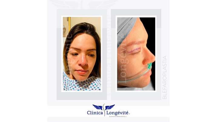 "Antes y después de un caso de éxito en la clínica Longevité, mostrando resultados de [nombre del procedimiento] y resaltando la evolución estética y armonía facial/corporal lograda."