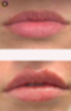 Before and After Lip Augmentation Minneapolis MN
