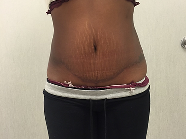 Tummy Tuck After