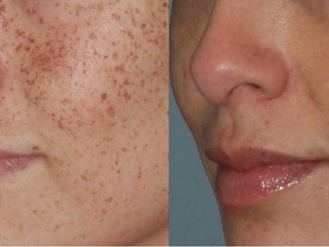 IPL Lumecca skin treatment BEFORE and AFTER