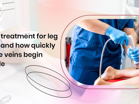 Laser treatment for leg veins and how quickly visible veins begin to fade