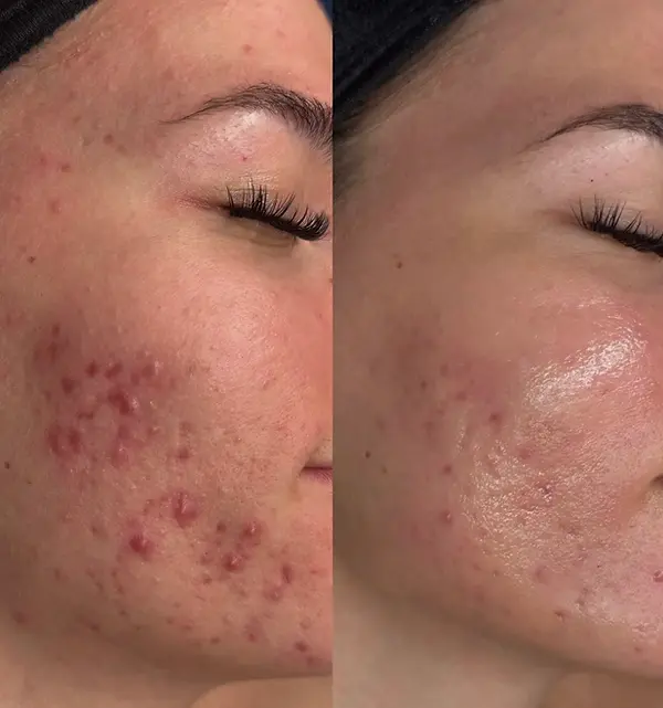 acne 1.webp