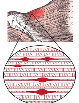 Balancing Trigger Points