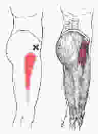 TFL pain referral pattern