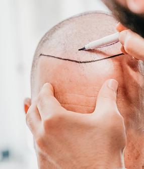 Photo of a hair transplant specialist designing or marking a natural hairline. Before hair