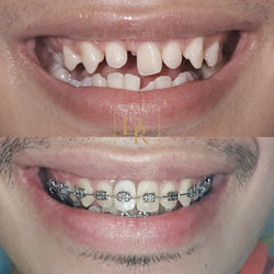 Missing Tooth Braces