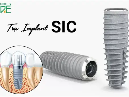 Tìm hiểu về trụ Implant SIC: Xuất xứ, cấu tạo, ưu nhược điểm