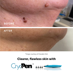 Skin Tag Removal Waterlooville