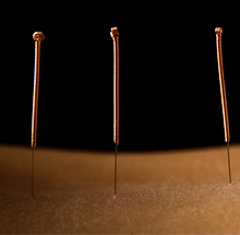 Acupuncture Therapy Scene_edited.png