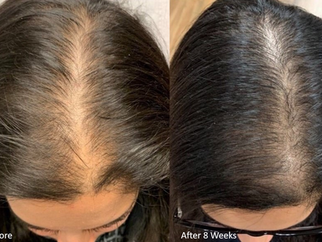 Hair growth treatments in Sudbury
