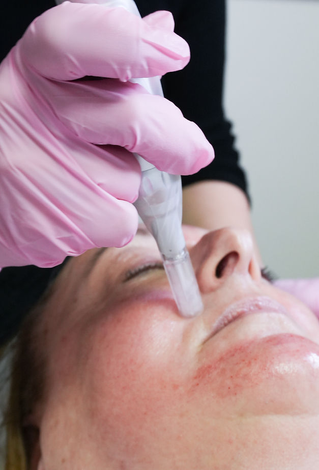 Microneedling