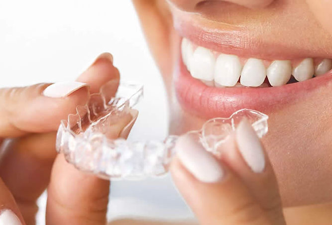 Guarda-oclusal.jpg