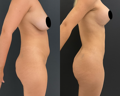Masto com Prótese + Lipo + Argoplasma + Morpheus no Gluteo - 2.png