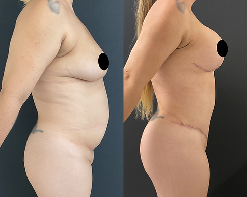 Lipo com Argo + Abdominoplastia + Mastopexia com Prótese E2.png