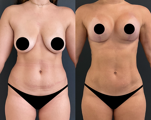 Lipo com Argo + Masto com Prótese - 1 (2).png