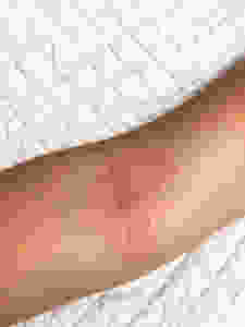 arm with slight eczema flare up