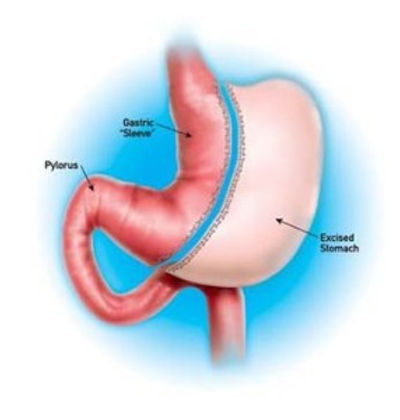 gastric sleeve.jpg
