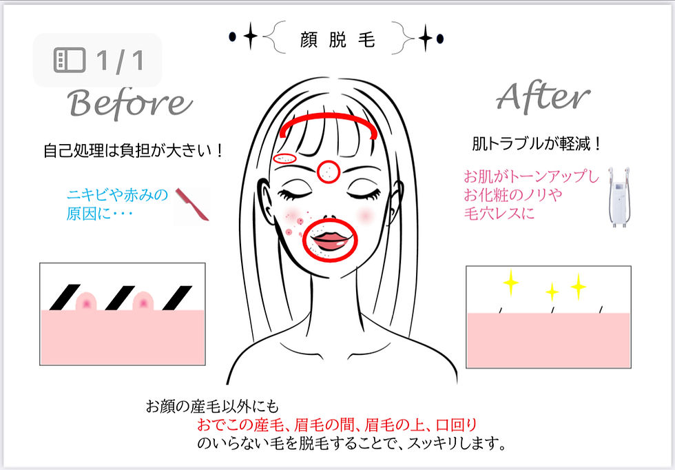 顔脱毛