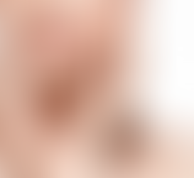 光フェイシャル（IPLの光）を続けてると10年後は？