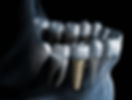 Animated view of a dental implant