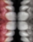 anterior teeth view of a beautiful and healthy smile