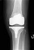total knee replacement