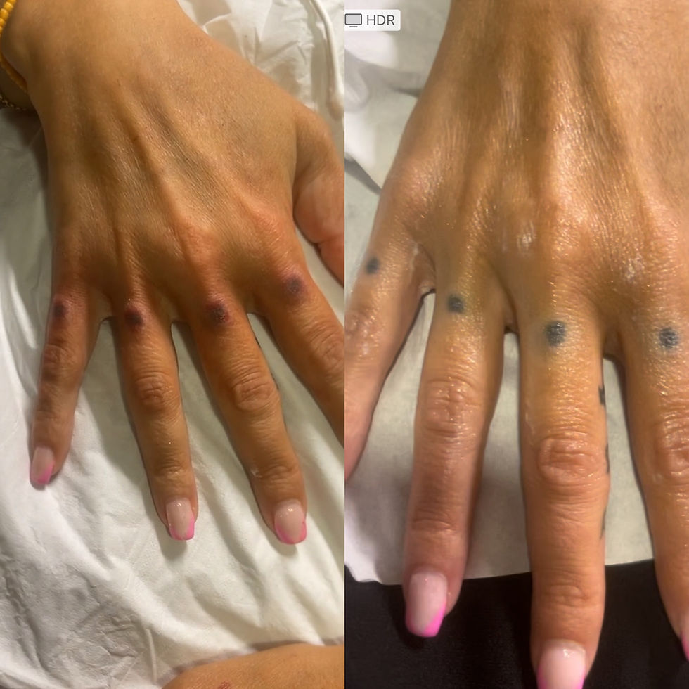 Miniature : Détatouage naturel (sans acide lactique  ni laser) (Prestation )