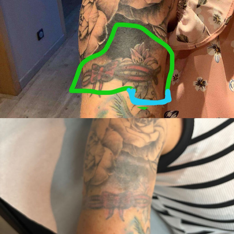 Miniature : Détatouage naturel (sans acide lactique  ni laser) (Prestation )