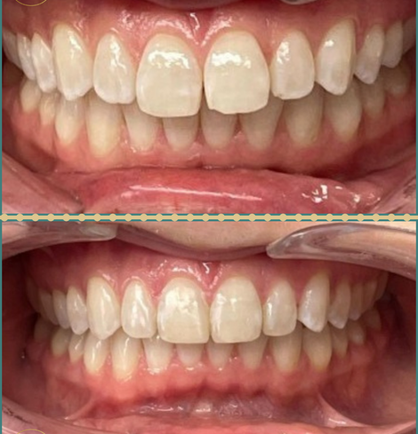 Before and after teeth whitening comparison, showing text, Dr. Priya Dental & Aesthetics