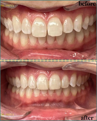 Before and after teeth whitening comparison, showing text, Dr. Priya Dental & Aesthetics