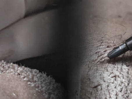 Hybrid Hair Transplant in Indonesia – IstanbulHairIndonesia