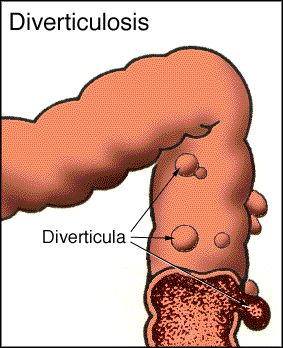 gi_divert1.gif