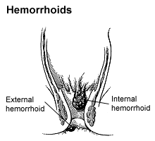 Hemorrhoids
