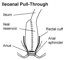 Ileoanal Pull-Through