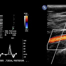 ecografia ultrasound doppler arterial arterias circulaci贸n vascular pierna