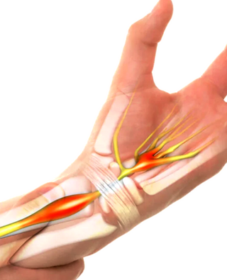 CARPAL TUNNEL SYNDROME