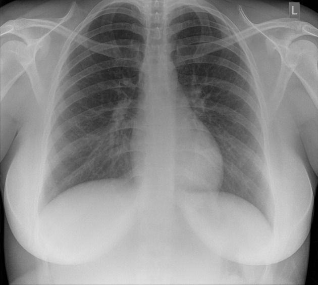 ▼ IMAGEN 1 — Insertar aquí: normal_chest_radiograph.jpeg | Alt SEO: Radiografía de tórax PA normal — anatomía radiológica de referencia | Dr. Segnini