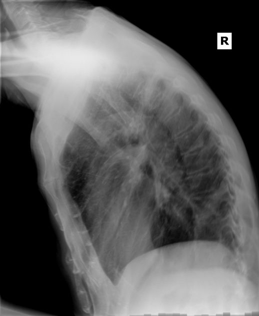 ▼ IMAGEN 2 — Insertar aquí: lateral_chest_radiograph_normal.jpeg | Alt SEO: Radiografía de tórax proyección lateral derecha normal — correlación con proyección PA | Dr. Segnini
