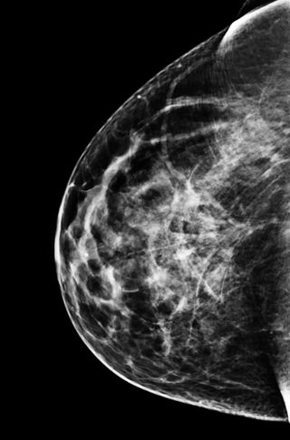 BREAST DENSITY ACCORDING TO THE ACR CLASSIFICATION