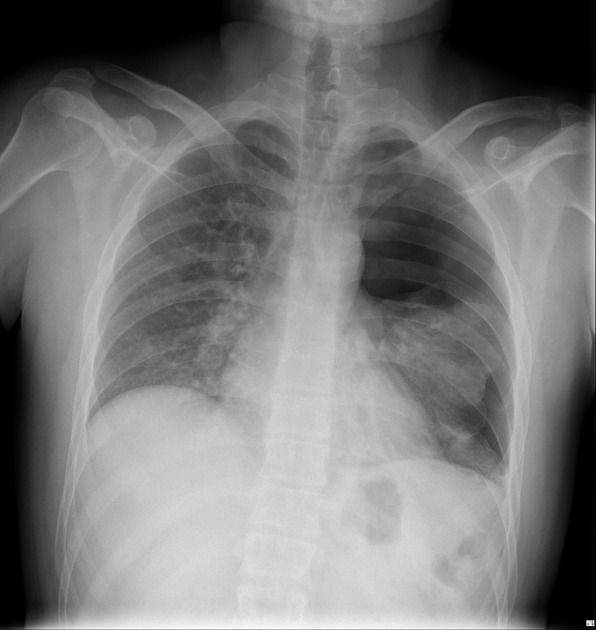 ▼ IMAGEN 3 — Insertar aquí: pneumothorax_chest_X-ray.jpeg | Alt SEO: Neumotórax izquierdo en radiografía de tórax PA — ausencia trama vascular periférica — punto E del método ABCDE | Dr. Segnini