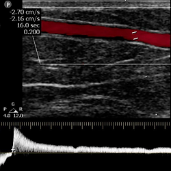 doppler ultrasound venoso trombosis insuficiencia venosa varices circulaci贸n